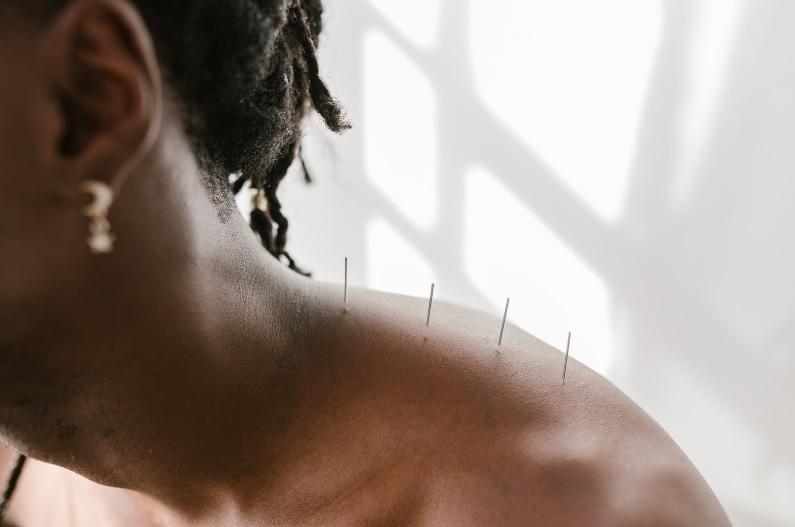 acupuncture